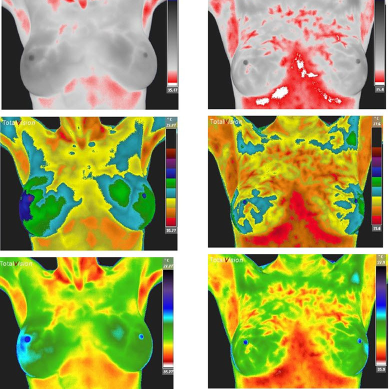 Breast Thermography & Hormones - Florida Medical Thermography