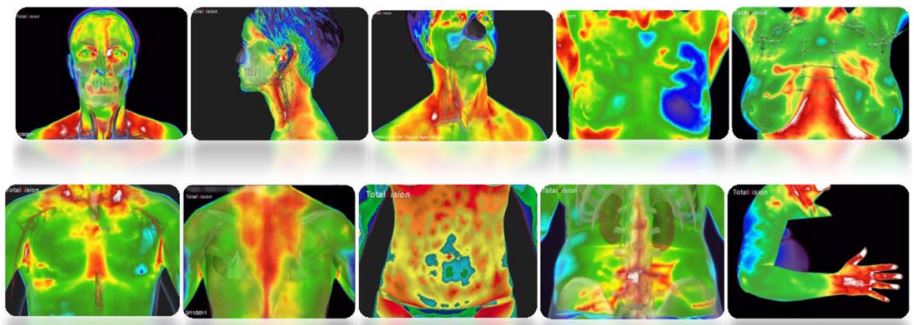 Thermography & Inflammation